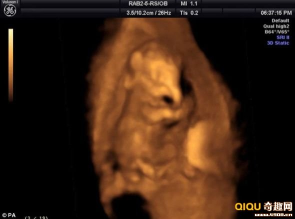 [多图]子宫内3月大小象胎儿照公布