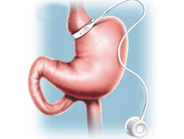 可调节胃束带手术与胃旁路旁路绕道手术的区别